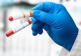 التنبؤ بالجلطات القلبية والسكتات الدماغية لدى النساء قبل 30 عاما من حدوثها